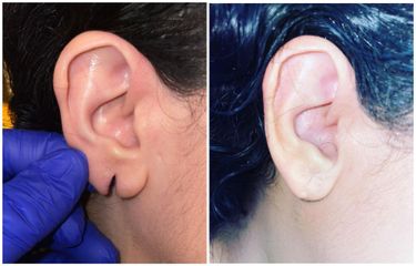 Trattamento chirurgico di schisi completa del lobo orecchie