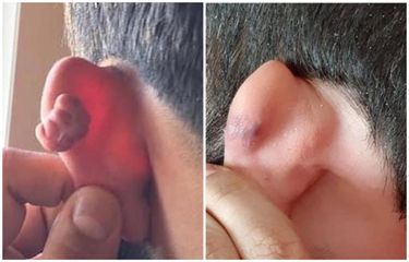 Trattamento di cheloide orecchio dopo piercing