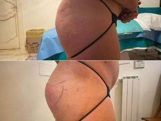 Gluteoplastica prima e dopo - 867006