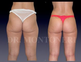 Liposcultura prima e dopo