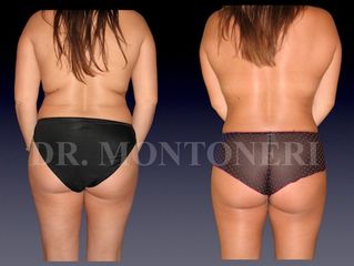Liposcultura prima e dopo