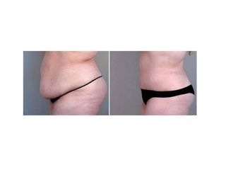 liposuzione prima dopo