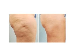 cellulite prima dopo