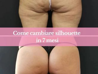 Carbossiterapia prima e dopo - 874104