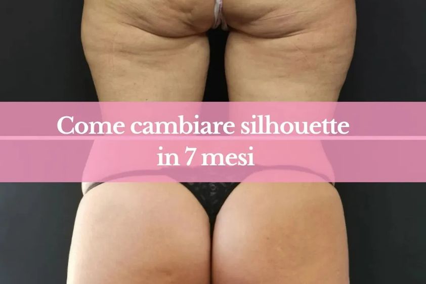 Carbossiterapia prima e dopo - 874104