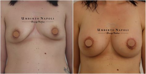 Mastoplastica additiva - Dott. Umberto Napoli