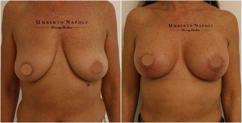 Mastopessi - Dott. Umberto Napoli