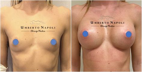 Mastoplastica additiva - Dott. Umberto Napoli