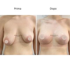 Dott. Umberto Napoli_Mastopessi additiva