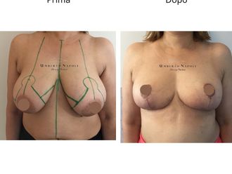 Mastopessi prima e dopo - 881059