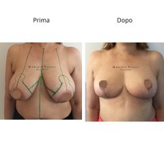 Dott. Umberto Napoli_Mastopessi additiva