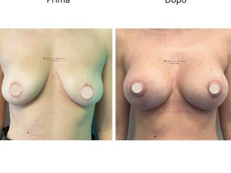 Mastopessi prima e dopo - 881063