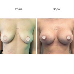 Dott. Umberto Napoli_Mastopessi additiva