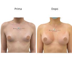 Dr Napoli_Mastoplastica Additiva