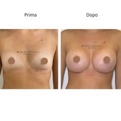 Dott. Umberto Napoli_Mastoplastica Additiva