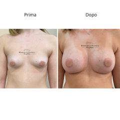Dott. Umberto Napoli_Mastoplastica Additiva
