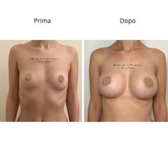 Dott. Umberto Napoli_Mastoplastica Additiva