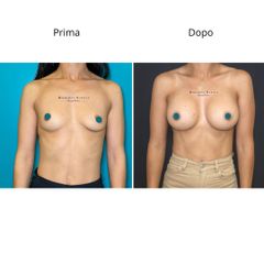 Dott. Umberto Napoli_Mastoplastica Additiva