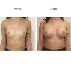 Dott. Umberto Napoli_Mastoplastica Additiva