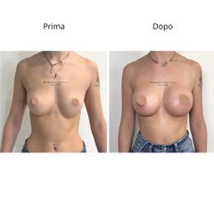 Dott. Umberto Napoli_Mastoplastica Additiva