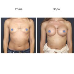 Dott. Umberto Napoli_Mastoplastica Additiva