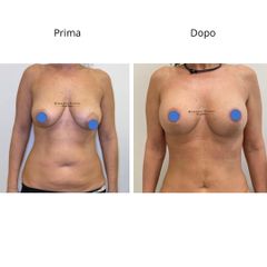 Dott. Umberto Napoli_Mastopessi additiva