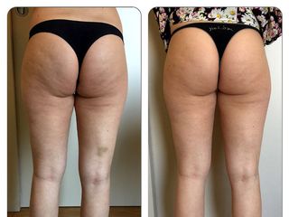 Mesoterapia prima e dopo