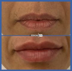 Filler labbra - Dott.ssa Caminiti Paola Medical SPA