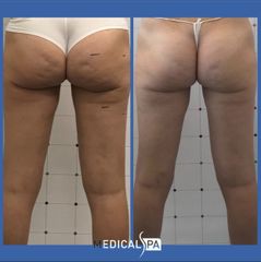 Cellulite - Dott.ssa Caminiti Paola Medical SPA