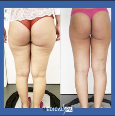 Cellulite - Dott.ssa Caminiti Paola Medical SPA