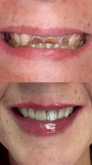 Dott.ssa Miriana Bellomo Filler labbra soft + corone in zirconia
