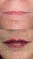 Dott.ssa Miriana Bellomo Filler Labbra