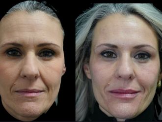 Botulino prima e dopo - 877358