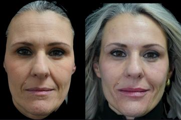 Dott.ssa Miriana Bellomo Full face botox