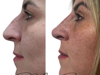 Rinofiller prima e dopo - 877359