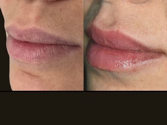 Filler labbra prima e dopo - 877360
