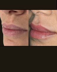 Dr. Miriana Bellomo Filler Labbra