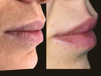 Filler labbra prima e dopo - 877361