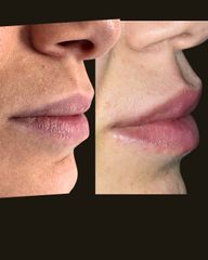 Dr. Miriana Bellomo Filler Labbra