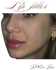 Dr. Miriana Bellomo Filler Labbra