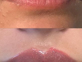 Filler labbra prima e dopo - 877363