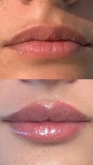 Dott.ssa Miriana Bellomo Filler Labbra