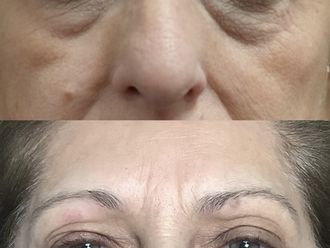 Eliminare occhiaie prima e dopo - 877364