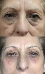 Dott.ssa Miriana Bellomo Filler solco lacrimale per occhiaie