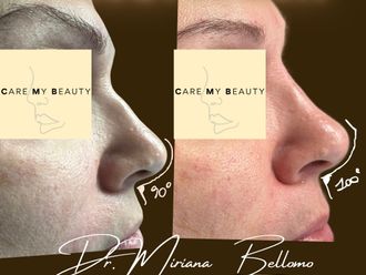 Rinofiller prima e dopo - 877365