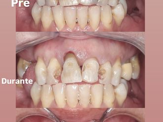 Faccette dentali prima e dopo - 877366