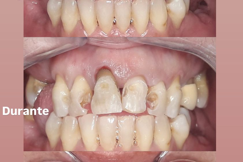 Faccette dentali prima e dopo - 877366