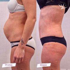 Liposcultura - Dott. Licata Giovanni