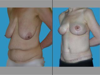 Mommy Makeover prima dopo