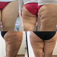 Cellulite - Dott.ssa Maria Gaetana Basile